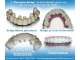 Dental Implants Gold Coast Dental Implants Gold Coast